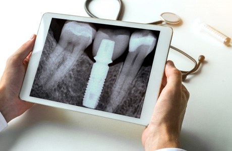 Held tablet showing X-ray of jaw with dental implant