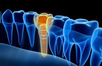 Digital illustration of an X-ray view of a placed dental implant