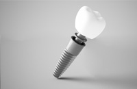 Illustrated dental implant with a dental crown against a gray background