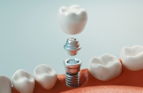 Illustration of a dental implant abutment and crown being placed in the lower jaw