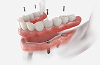 Illustrated full denture being fixed onto four dental implants